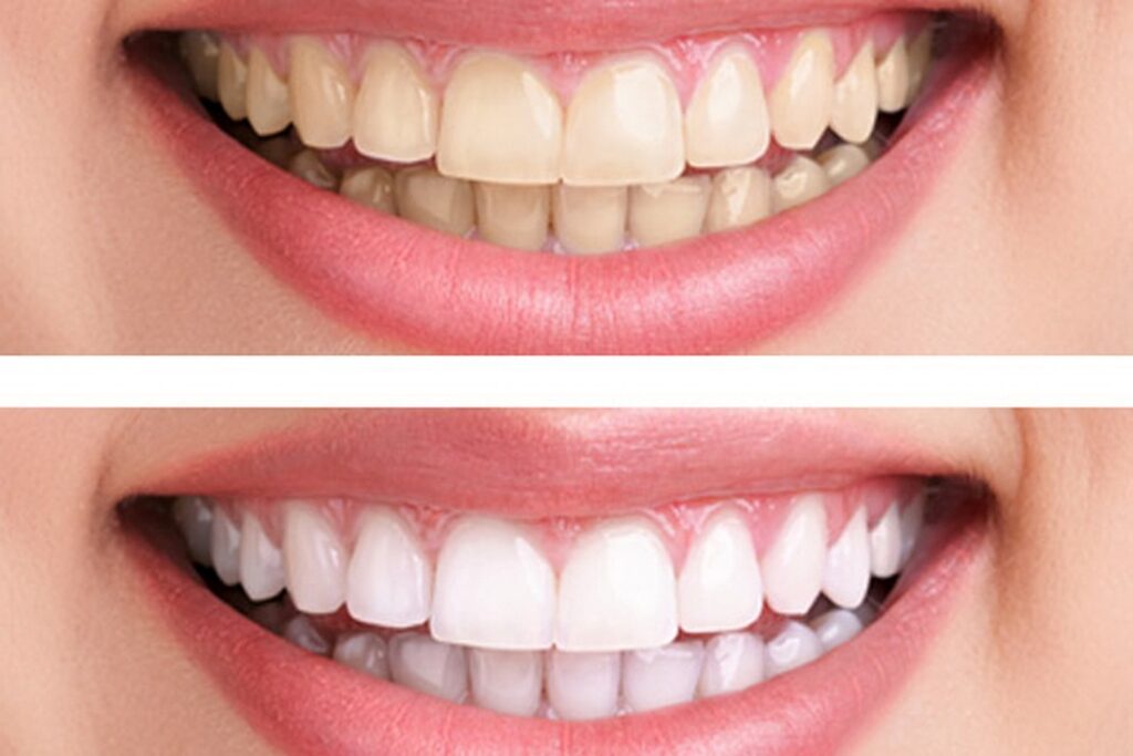 Bleaching Teeth Whitening in Sharda Nagar, Kanpur