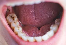 Best Treatment of Tooth Decay in Kalyanpur